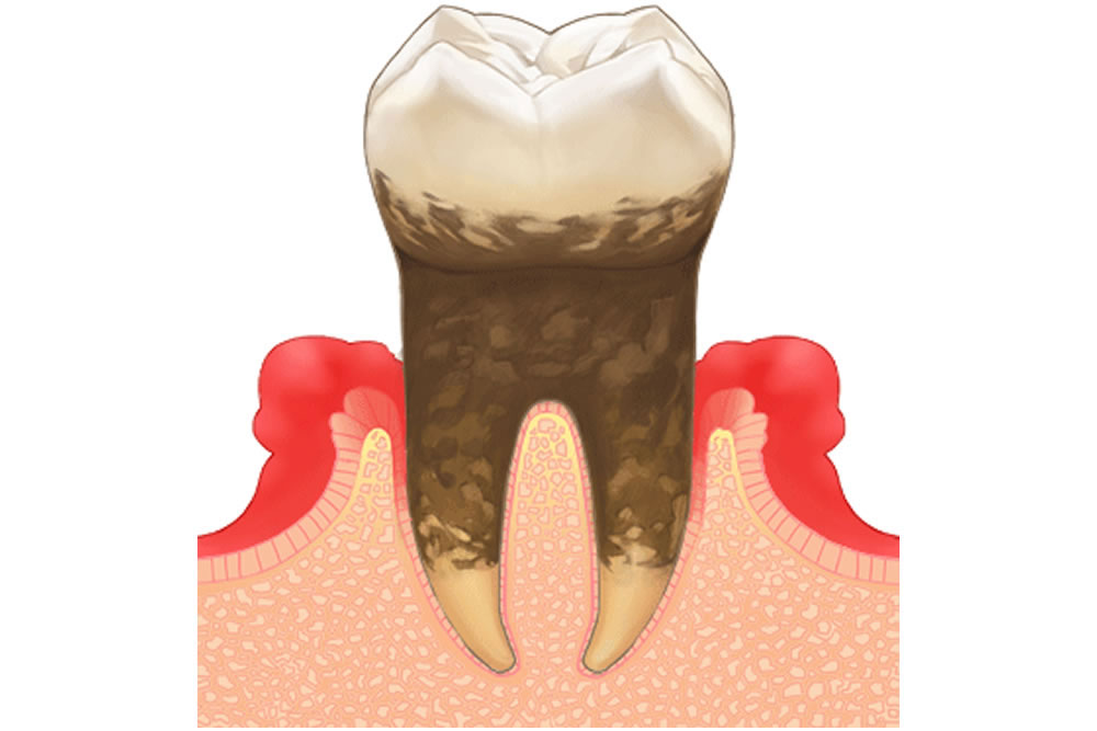 歯周病の原因・症状について